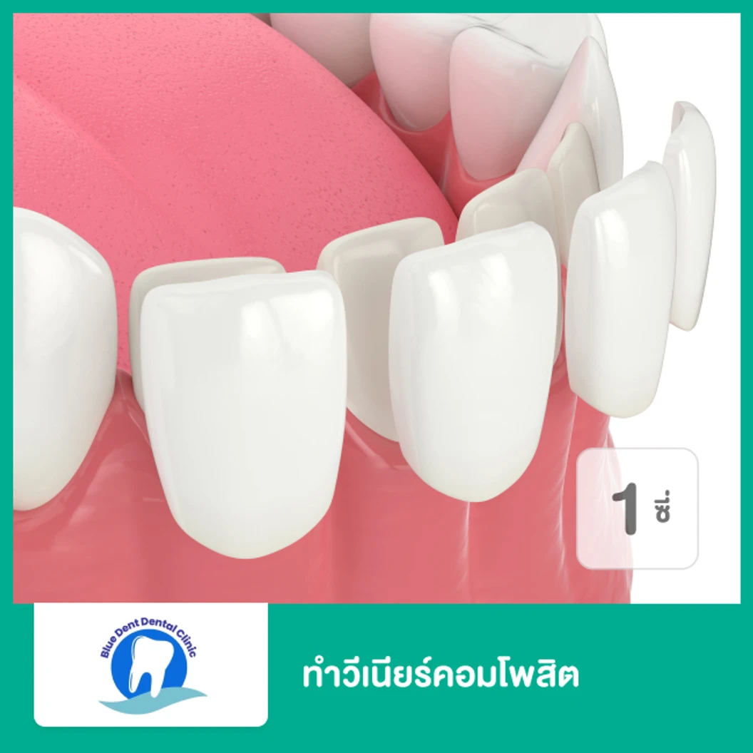 ทำวีเนียร์คอมโพสิต สำหรับฟัน 1 ซี่