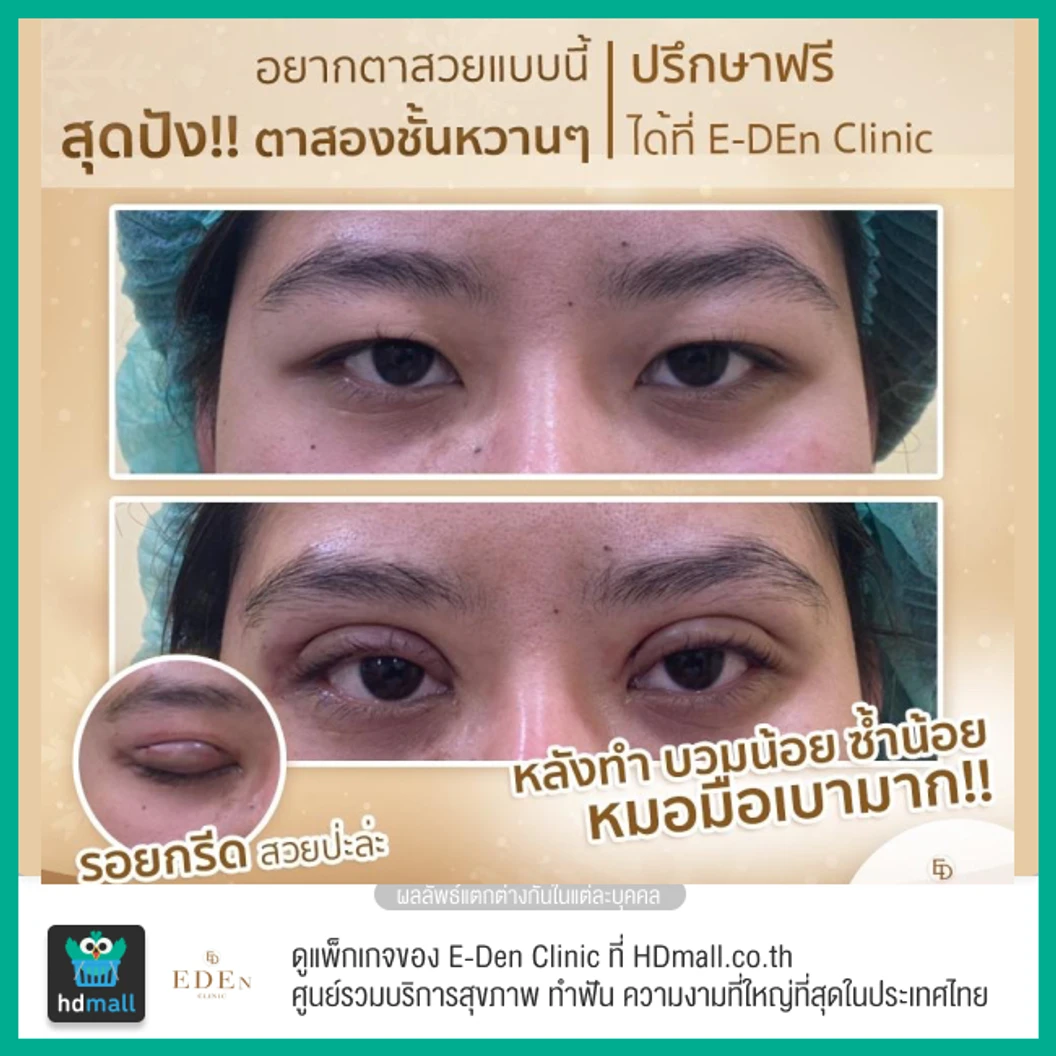 ทำตาสองชั้น แบบกรีดยาว สำหรับเคสทำครั้งแรก 1 ครั้ง