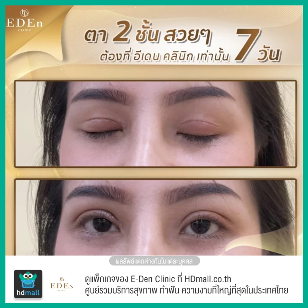 ทำตาสองชั้น แบบกรีดยาว สำหรับเคสทำครั้งแรก 1 ครั้ง