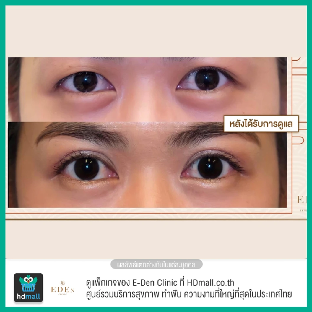 ทำตาสองชั้น แบบกรีดยาว สำหรับเคสทำครั้งแรก 1 ครั้ง