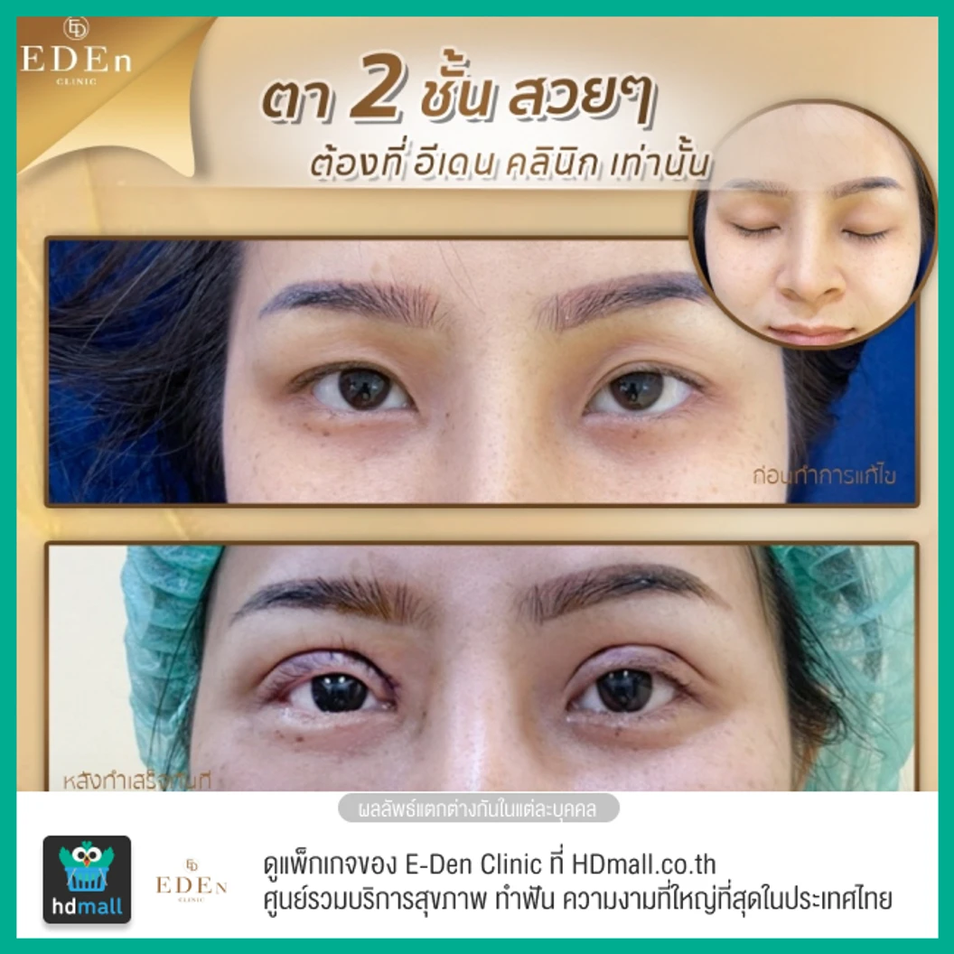 ทำตาสองชั้น แบบกรีดยาว สำหรับเคสทำครั้งแรก 1 ครั้ง