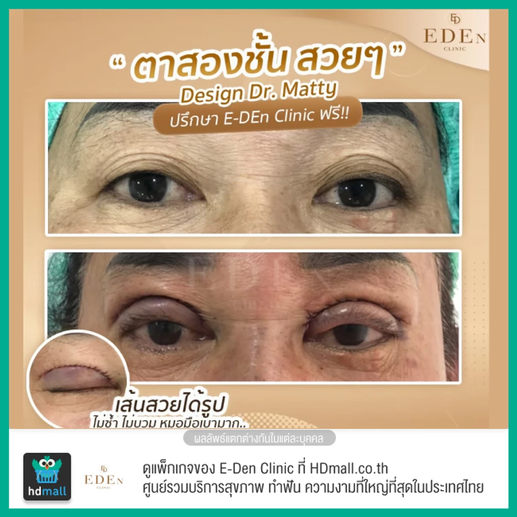 ทำตาสองชั้น แบบกรีดยาว สำหรับเคสทำครั้งแรก 1 ครั้ง