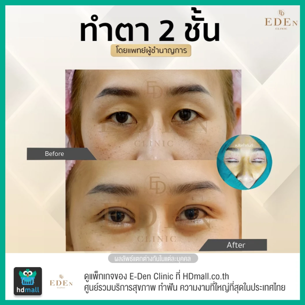 ทำตาสองชั้น แบบกรีดยาว สำหรับเคสทำครั้งแรก 1 ครั้ง