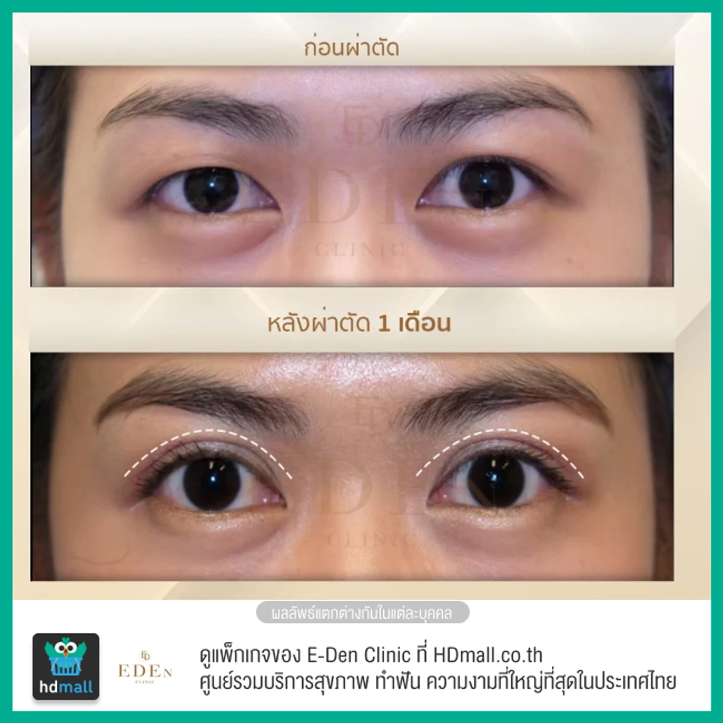 ทำตาสองชั้น แบบกรีดยาว สำหรับเคสทำครั้งแรก 1 ครั้ง