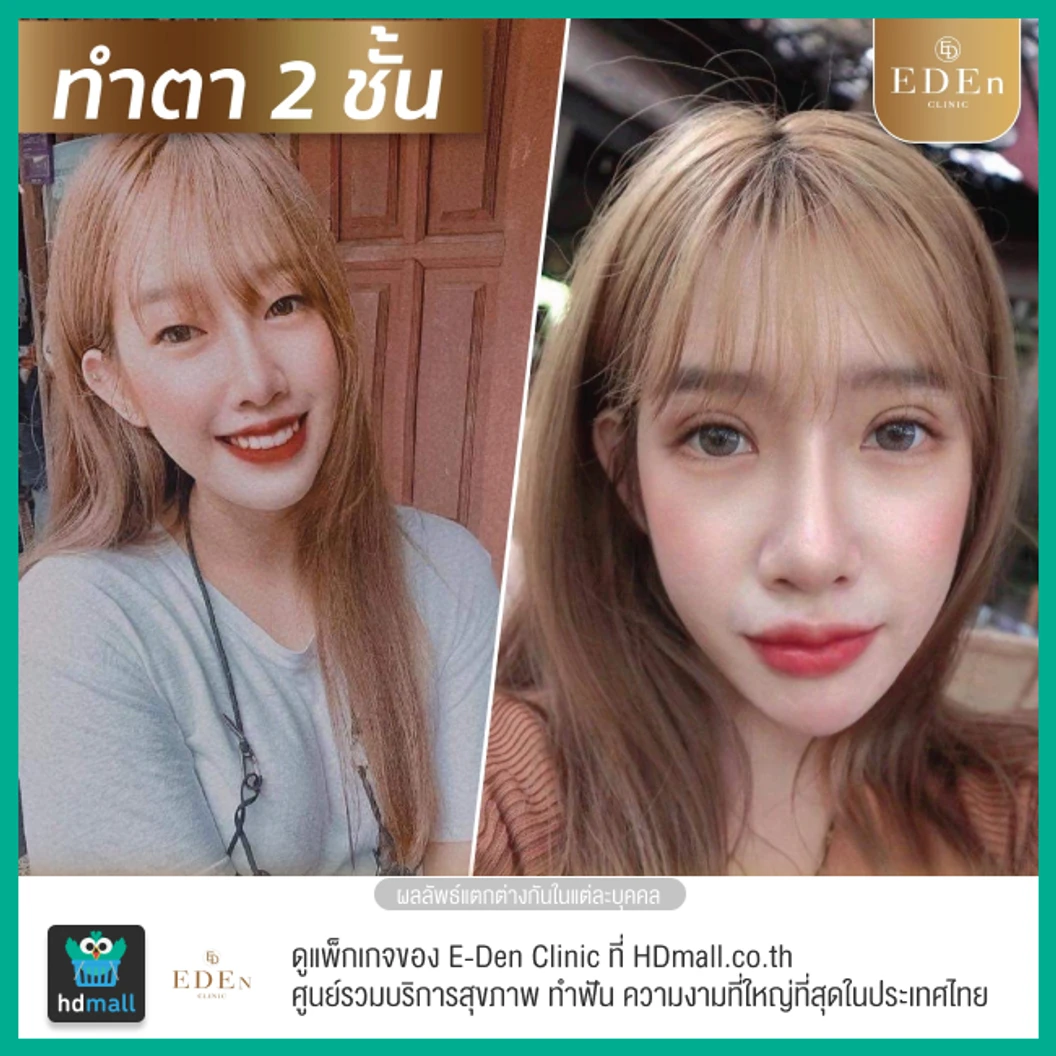 ทำตาสองชั้น แบบกรีดยาว สำหรับเคสทำครั้งแรก 1 ครั้ง