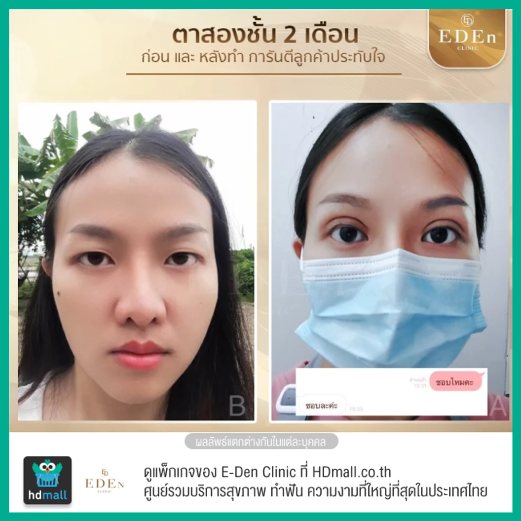 ทำตาสองชั้น แบบกรีดยาว สำหรับเคสทำครั้งแรก 1 ครั้ง