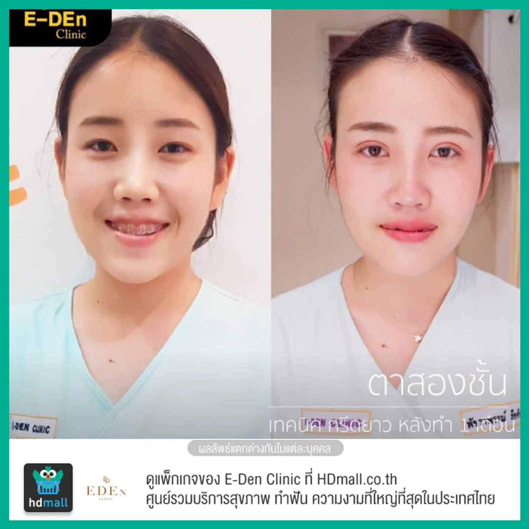 ทำตาสองชั้น แบบกรีดยาว สำหรับเคสทำครั้งแรก 1 ครั้ง