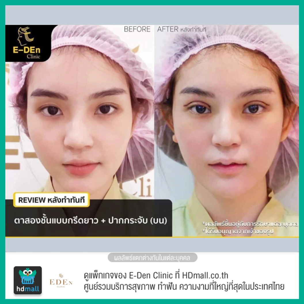 ทำตาสองชั้น แบบกรีดยาว สำหรับเคสทำครั้งแรก 1 ครั้ง