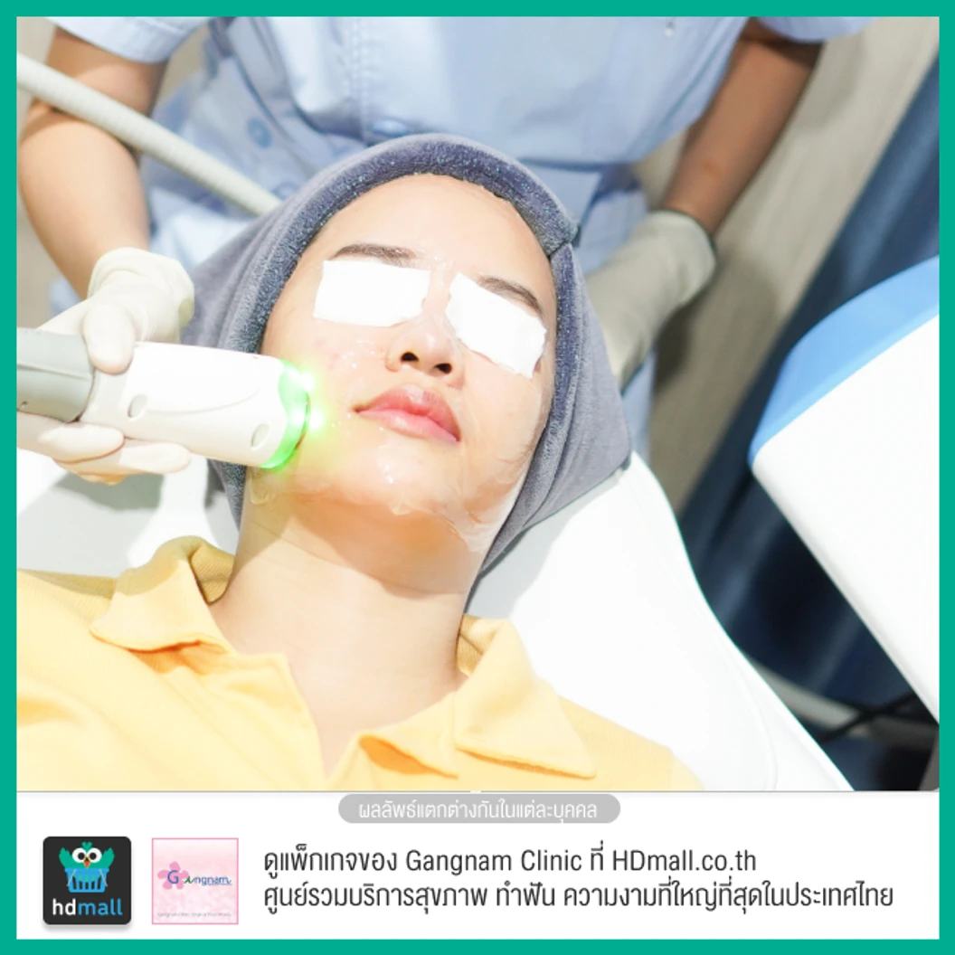 ทำทรีตเมนต์ New Pora Cool เติมวิตามินผิว ให้ผิวแข็งแรง กระจ่างใส ชุ่มชื้น รูขุมขนดูเล็กลง 1 ครั้ง