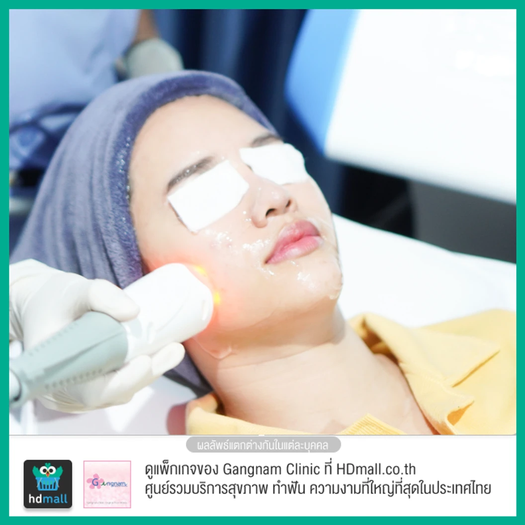 ทำทรีตเมนต์ New Pora Cool เติมวิตามินผิว ให้ผิวแข็งแรง กระจ่างใส ชุ่มชื้น รูขุมขนดูเล็กลง 1 ครั้ง