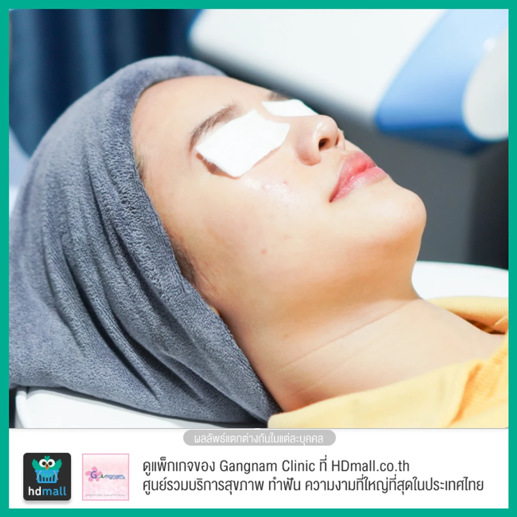 ทำทรีตเมนต์ New Pora Cool เติมวิตามินผิว ให้ผิวแข็งแรง กระจ่างใส ชุ่มชื้น รูขุมขนดูเล็กลง 1 ครั้ง