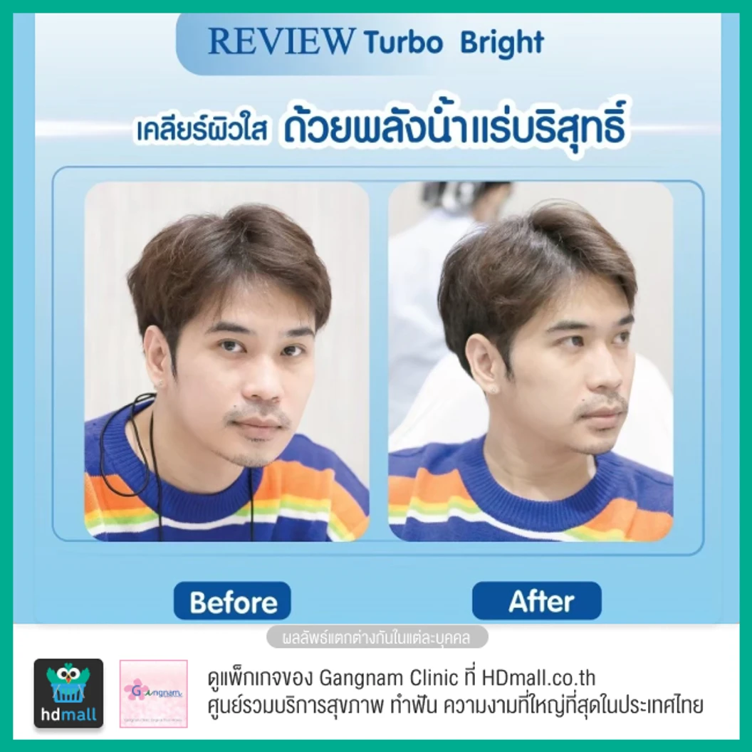 ทำทรีตเมนต์หน้า Turbo Bright ปรับสภาพผิวให้ดูกระจ่างใส 1 ครั้ง