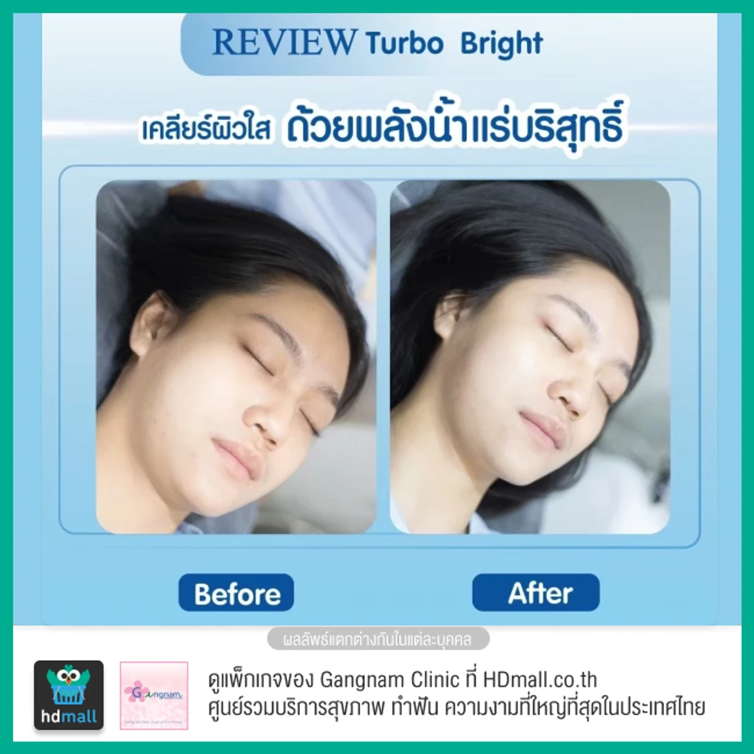 ทำทรีตเมนต์หน้า Turbo Bright ปรับสภาพผิวให้ดูกระจ่างใส 1 ครั้ง