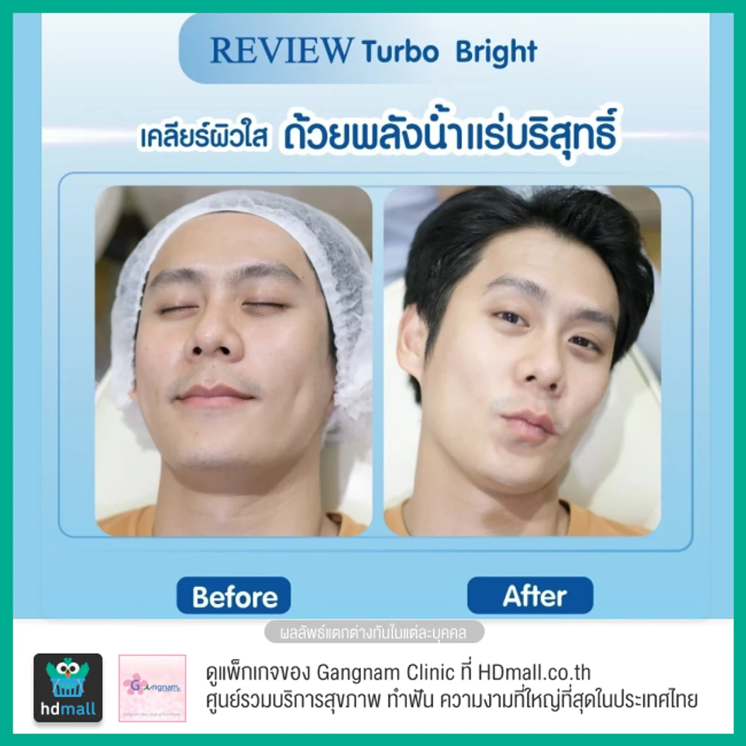 ทำทรีตเมนต์หน้า Turbo Bright ปรับสภาพผิวให้ดูกระจ่างใส 1 ครั้ง