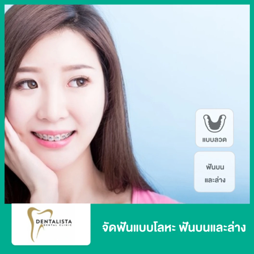 จัดฟันแบบโลหะ ฟันบนและล่าง