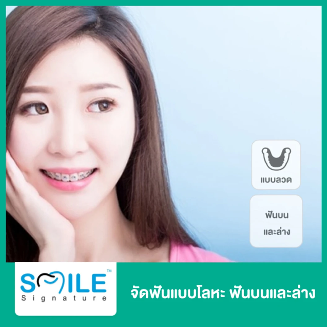 จัดฟันแบบโลหะ ฟันบนและล่าง