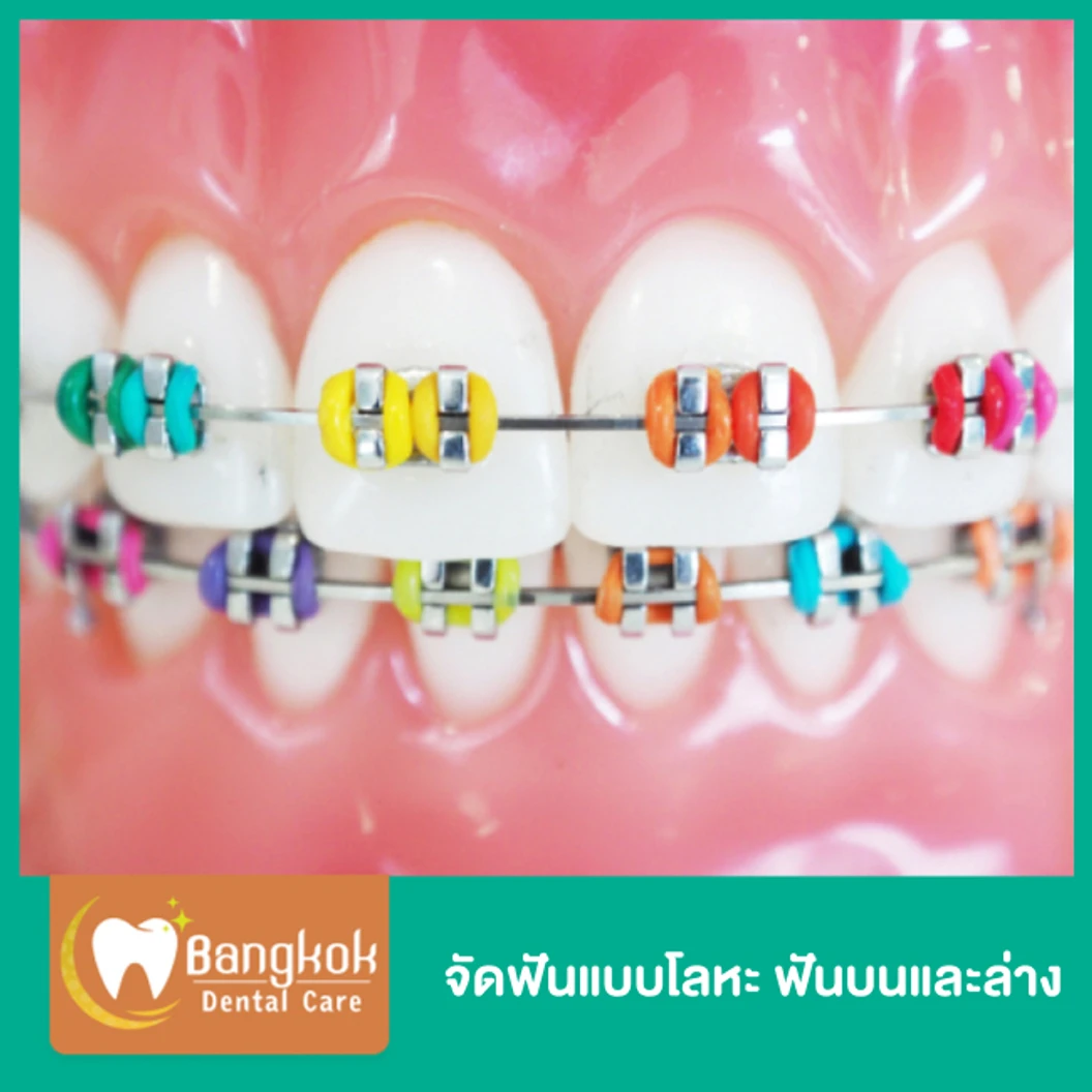 จัดฟันแบบโลหะ ฟันบนและล่าง