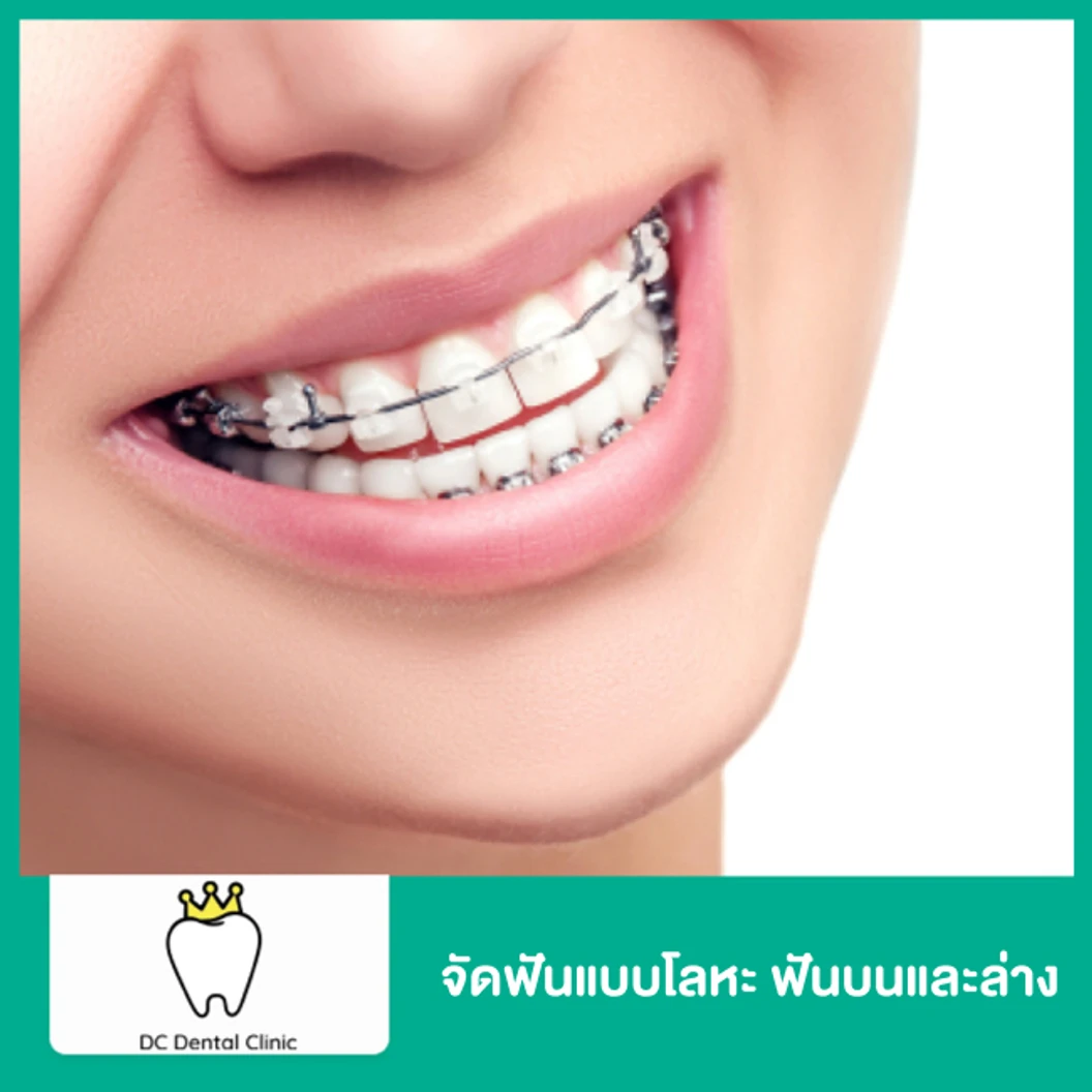 จัดฟันแบบโลหะ แบบแบร็กเกตใส ฟันบนและล่าง
