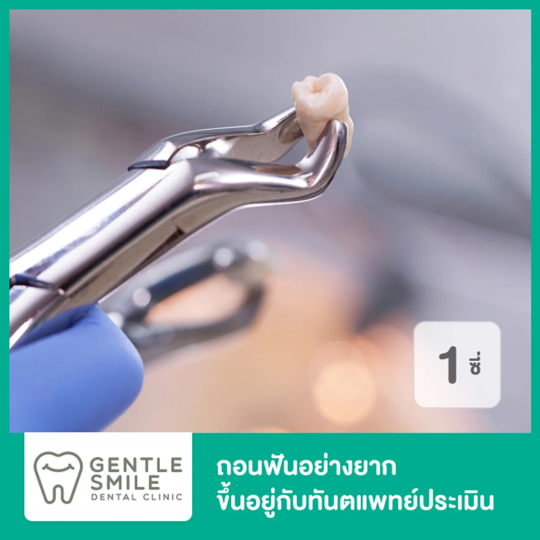 ถอนฟันอย่างยาก 1 ซี่ ขึ้นอยู่กับทันตแพทย์ประเมิน