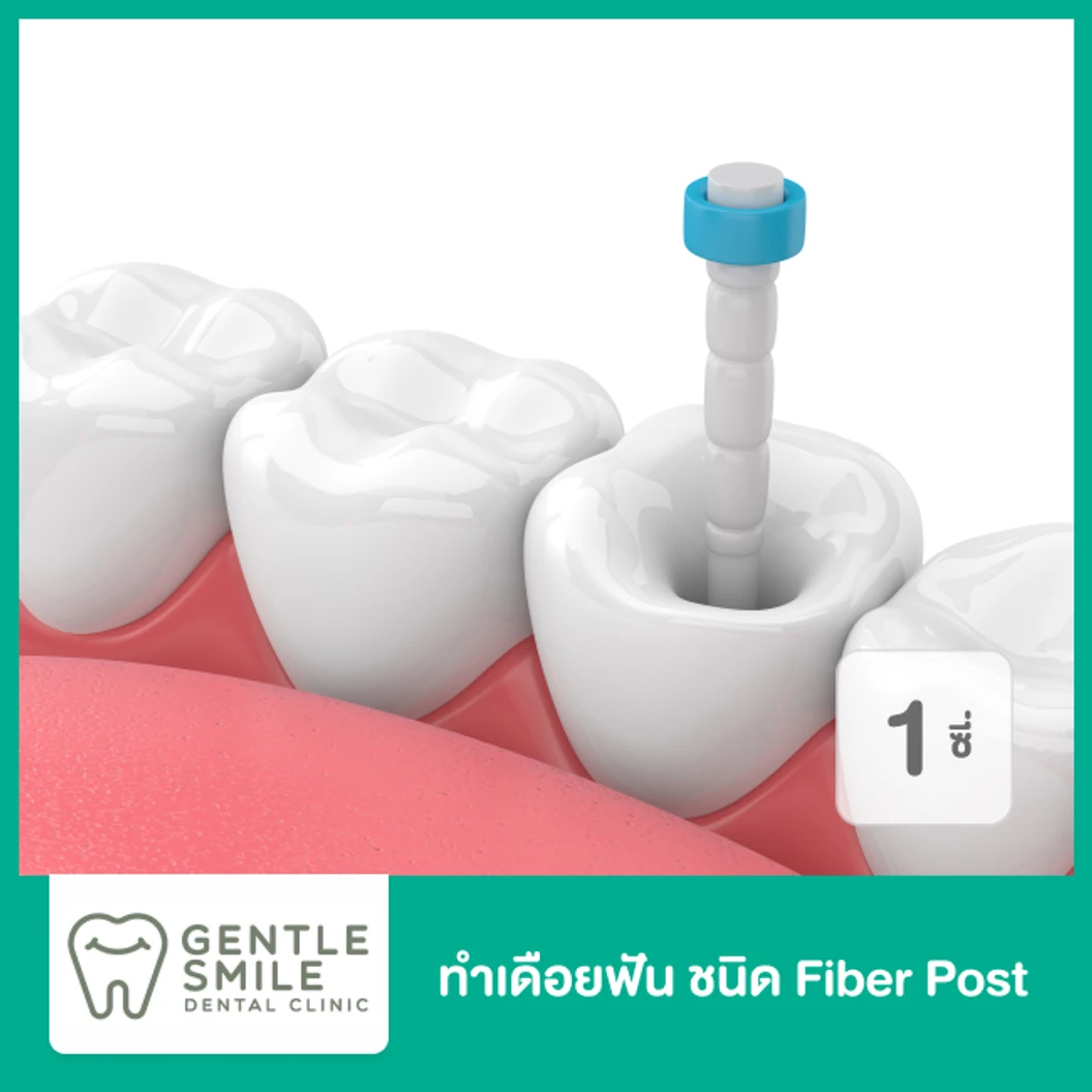 ทำเดือยฟัน ชนิด Fiber Post สำหรับฟัน 1 ซี่
