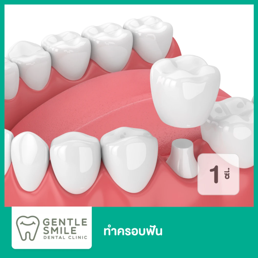 ทำครอบฟัน สำหรับฟัน 1 ซี่