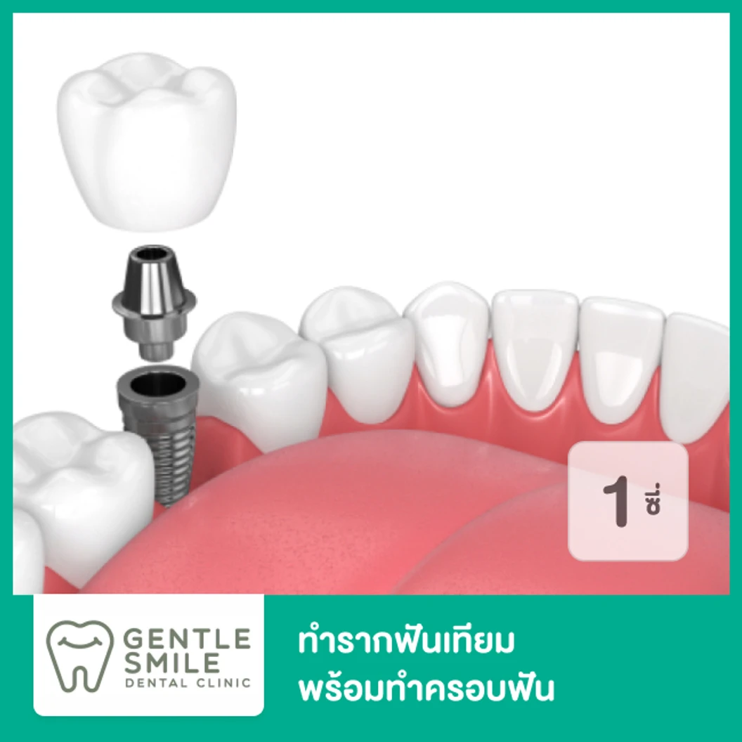 ทำรากฟันเทียม ยี่ห้อ Bego พร้อมทำครอบฟัน สำหรับฟัน 1 ซี่
