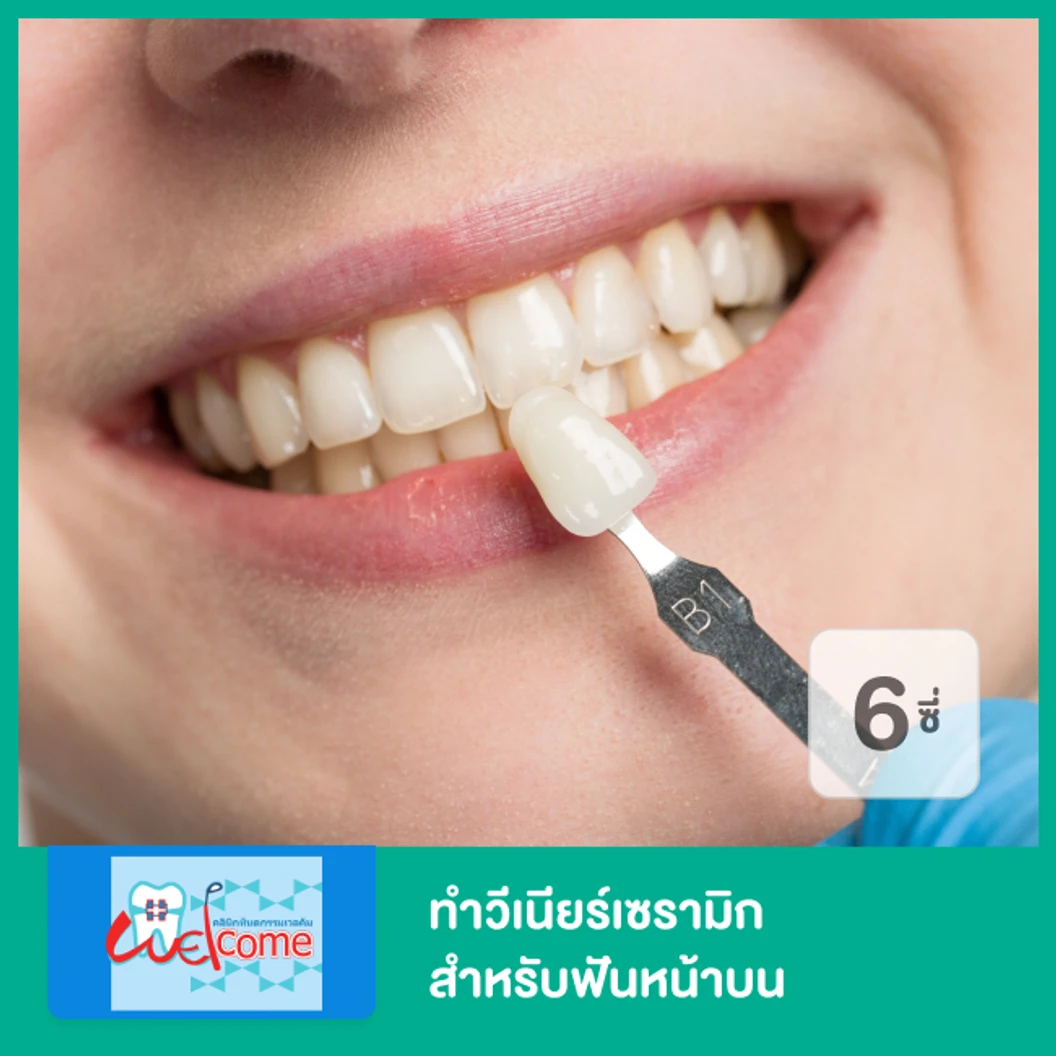 ทำวีเนียร์เซรามิก สำหรับฟันหน้าบน 6 ซี่