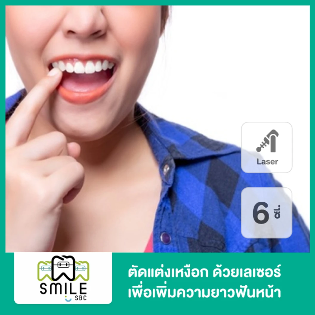 ตัดแต่งเหงือกด้วยเครื่อง Electrosurgery เพื่อเพิ่มความยาวฟันหน้า 6 ซี่