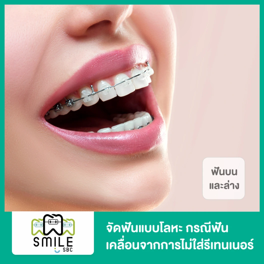 จัดฟันแบบโลหะ สำหรับฟันบนและล่าง กรณีฟันเคลื่อนจากการไม่ใส่รีเทนเนอร์