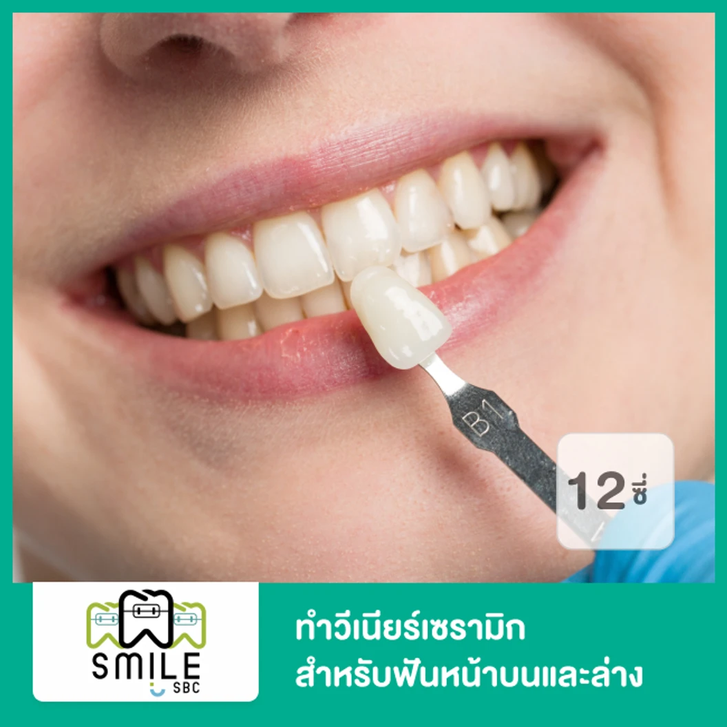 ทำวีเนียร์เซรามิก สำหรับฟันหน้าบนและล่าง 12 ซี่