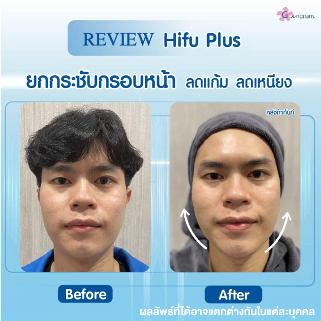 ทำ HIFU เครื่อง Ultra V HIFU Plus ไม่จำกัดช็อต บริเวณแก้มและร่องแก้ม 1 ครั้ง