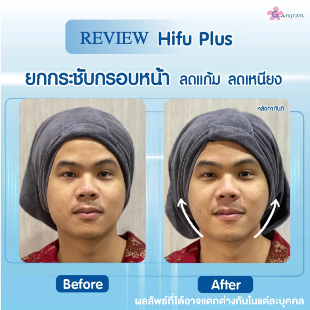 ทำ HIFU เครื่อง Ultra V HIFU Plus ไม่จำกัดช็อต บริเวณแก้มและร่องแก้ม 1 ครั้ง