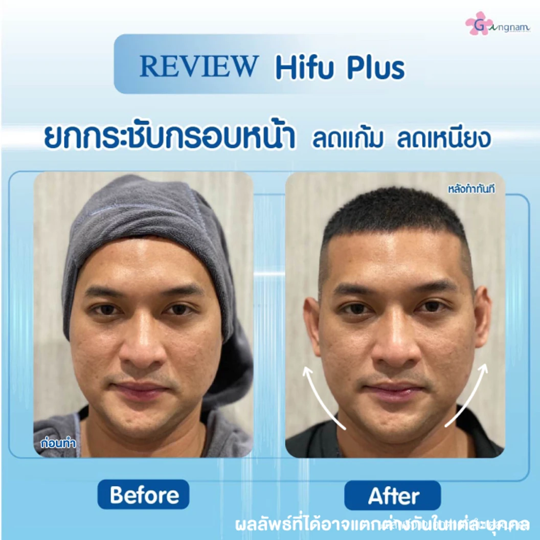 ทำ HIFU เครื่อง Ultra V HIFU Plus ไม่จำกัดช็อต บริเวณแก้มและร่องแก้ม 1 ครั้ง