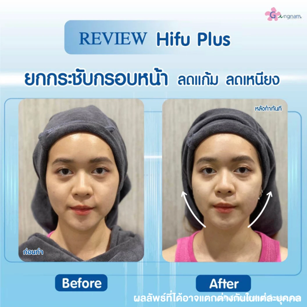 ทำ HIFU เครื่อง Ultra V HIFU Plus ไม่จำกัดช็อต บริเวณแก้มและร่องแก้ม 1 ครั้ง