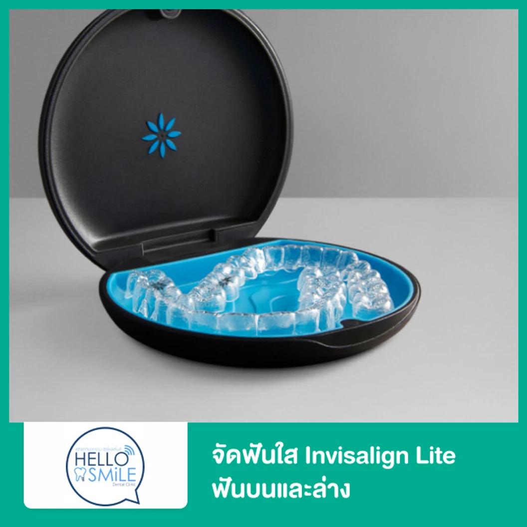 จัดฟันใส Invisalign Lite ฟันบนและล่าง