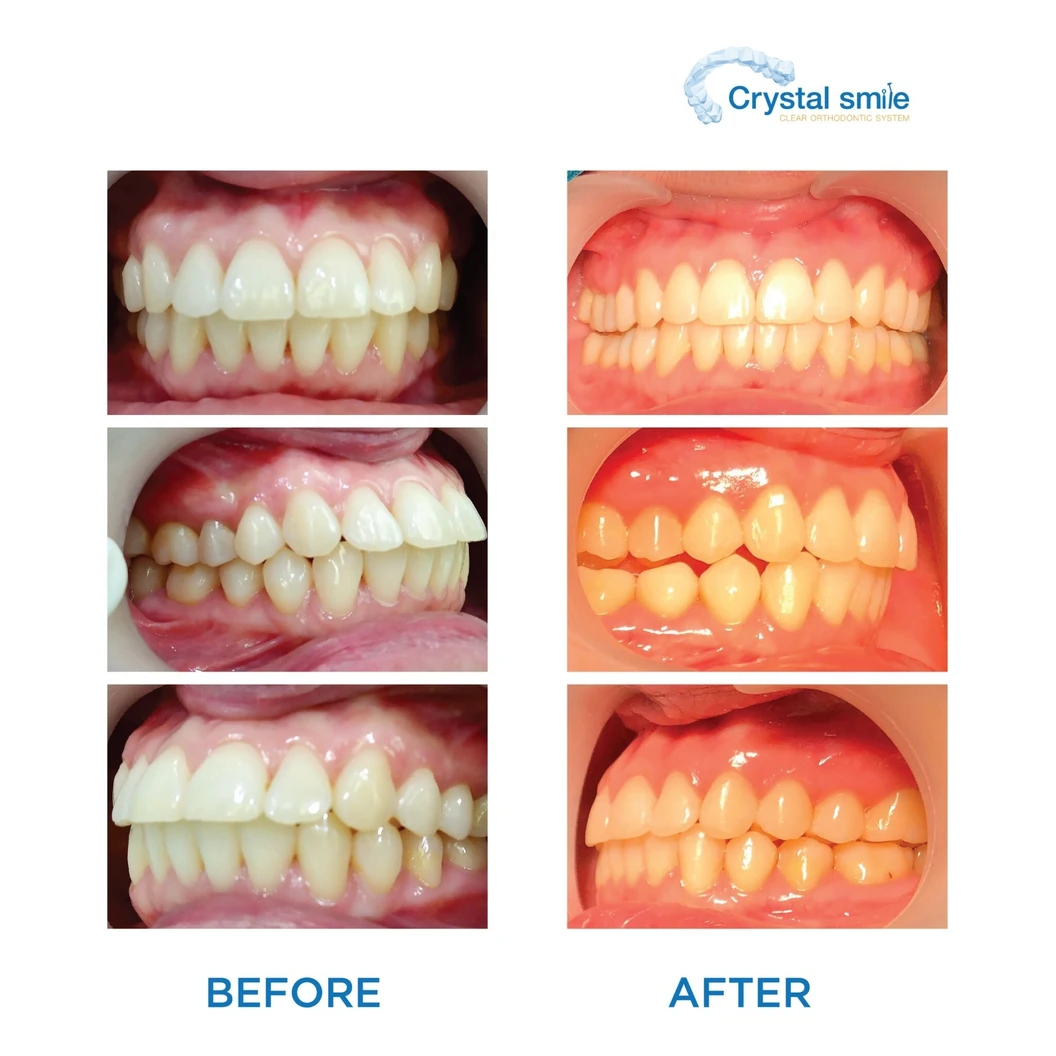 คอร์สจัดฟันแบบใส Crystal Smile Moderate ฟันบนและล่าง เครื่องมือไม่เกิน 20 ชิ้น