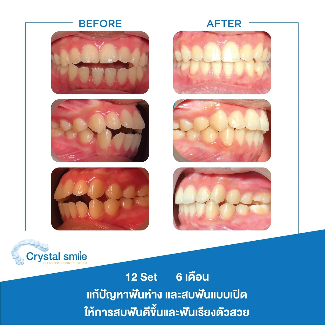 คอร์สจัดฟันแบบใส Crystal Smile Moderate ฟันบนและล่าง เครื่องมือไม่เกิน 20 ชิ้น
