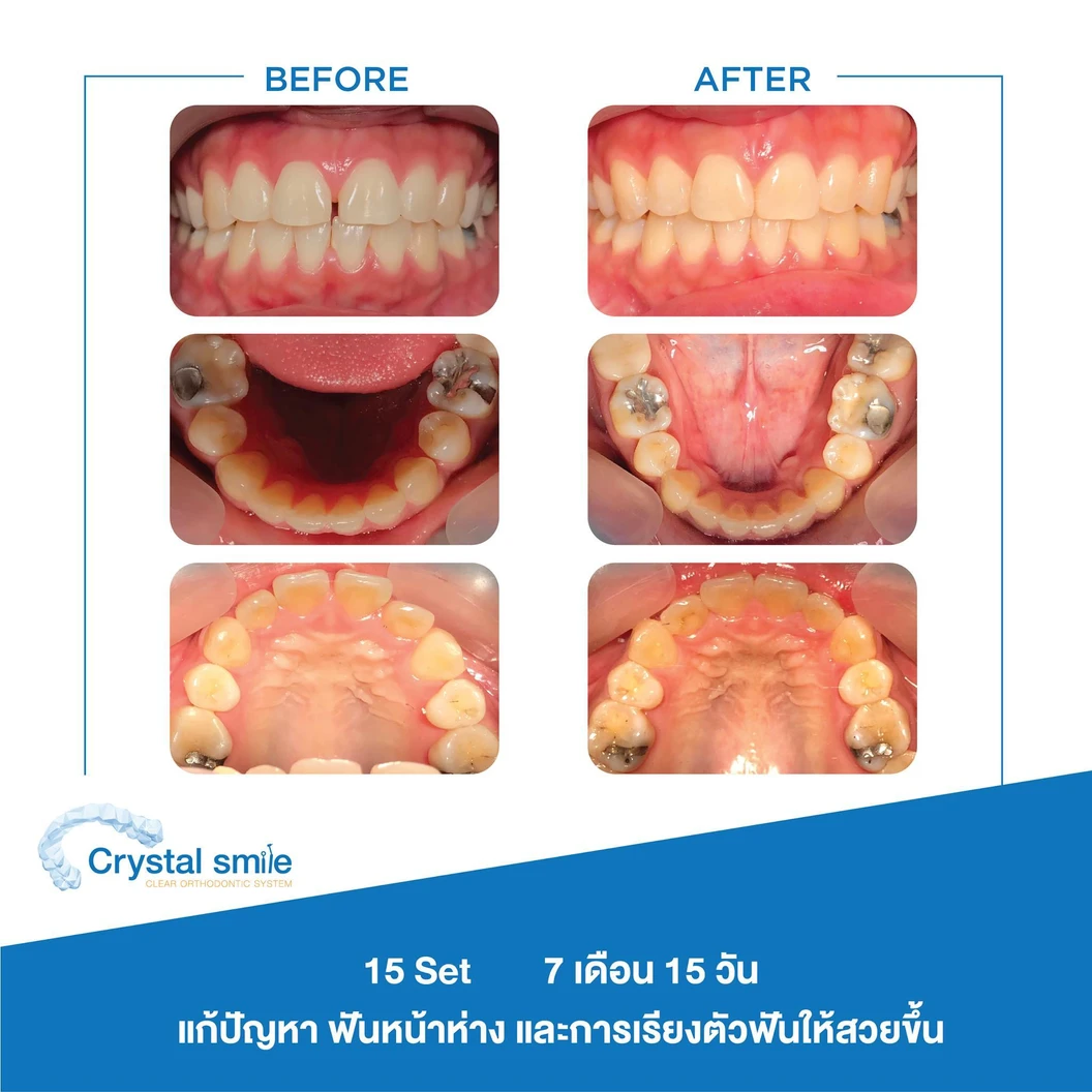 คอร์สจัดฟันแบบใส Crystal Smile Moderate ฟันบนและล่าง เครื่องมือไม่เกิน 20 ชิ้น