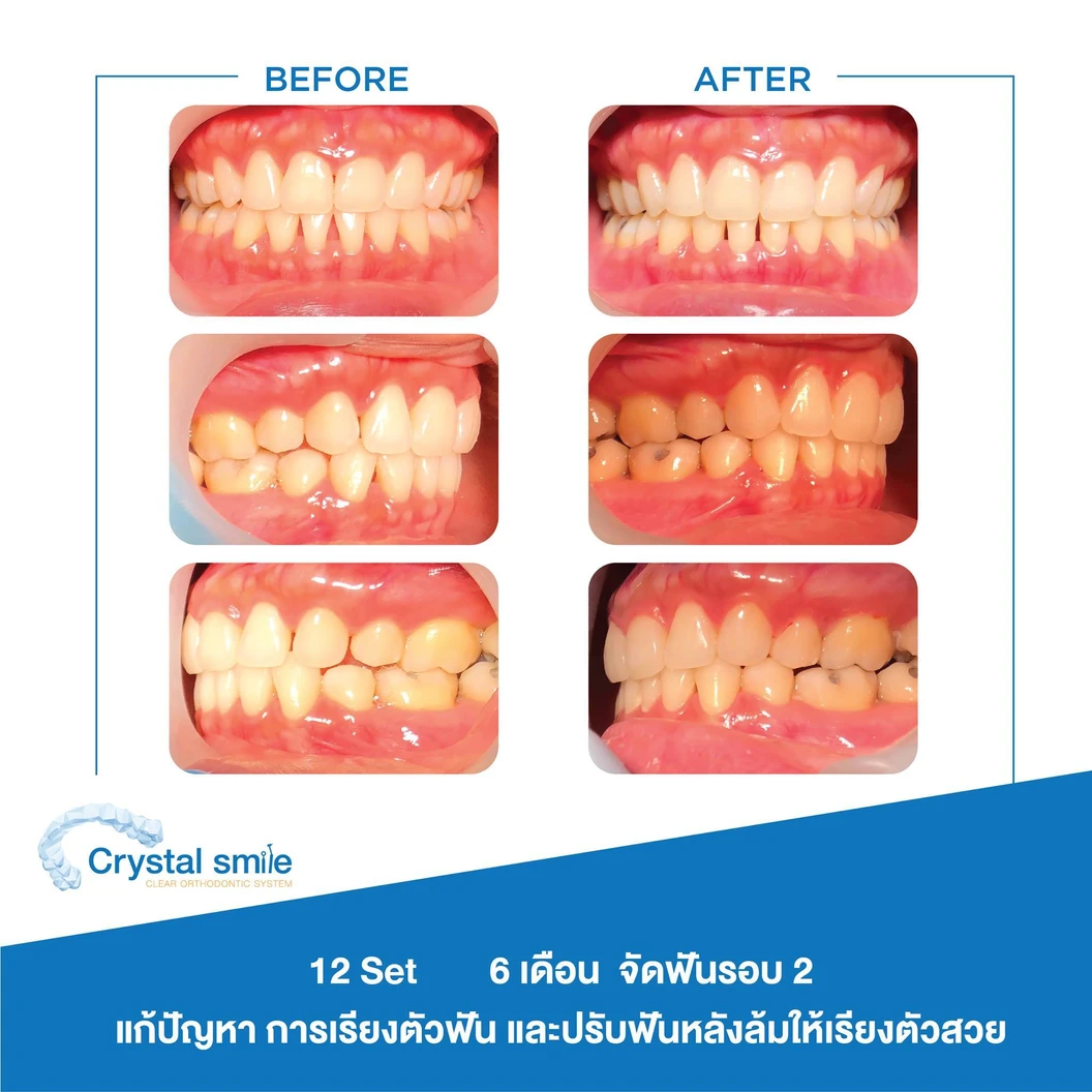 คอร์สจัดฟันแบบใส Crystal Smile Moderate ฟันบนและล่าง เครื่องมือไม่เกิน 20 ชิ้น