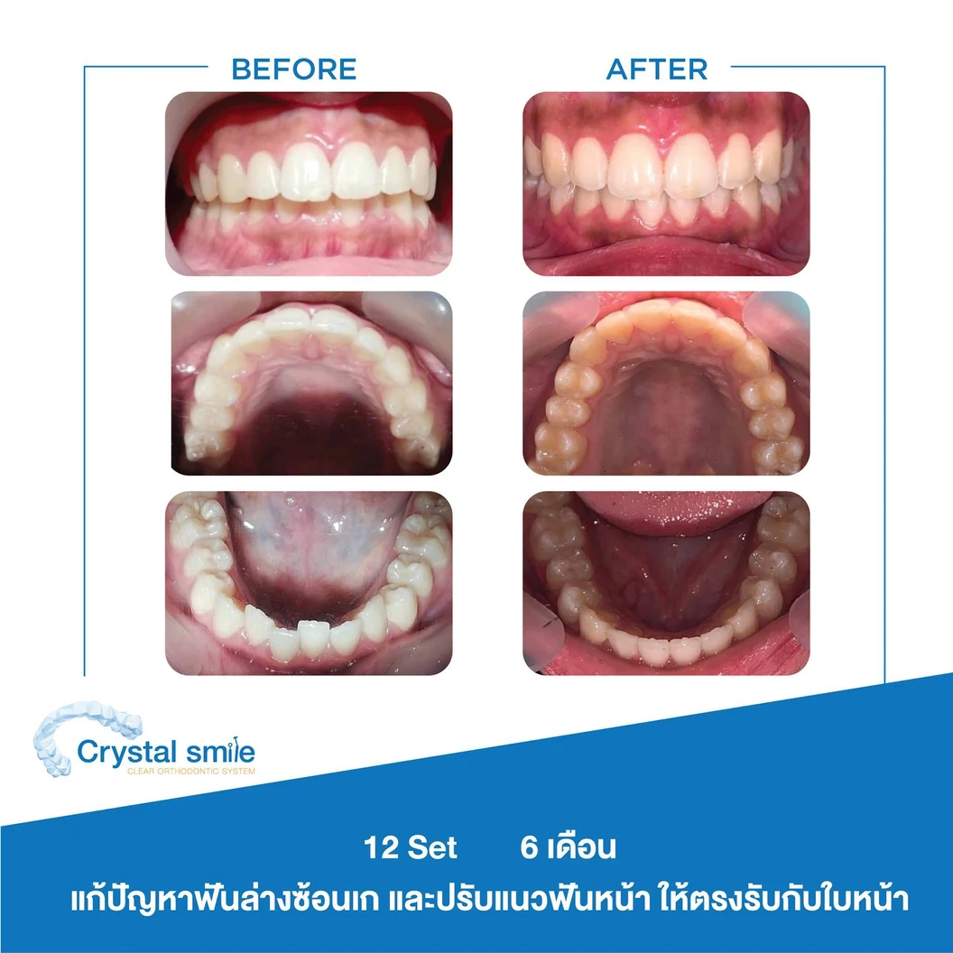 คอร์สจัดฟันแบบใส Crystal Smile Moderate ฟันบนและล่าง เครื่องมือไม่เกิน 20 ชิ้น