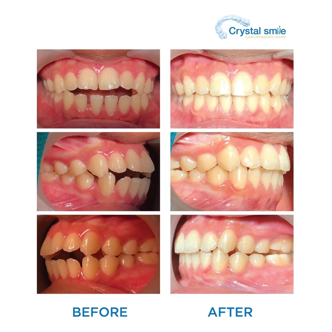 คอร์สจัดฟันแบบใส Crystal Smile Moderate ฟันบนและล่าง เครื่องมือไม่เกิน 20 ชิ้น