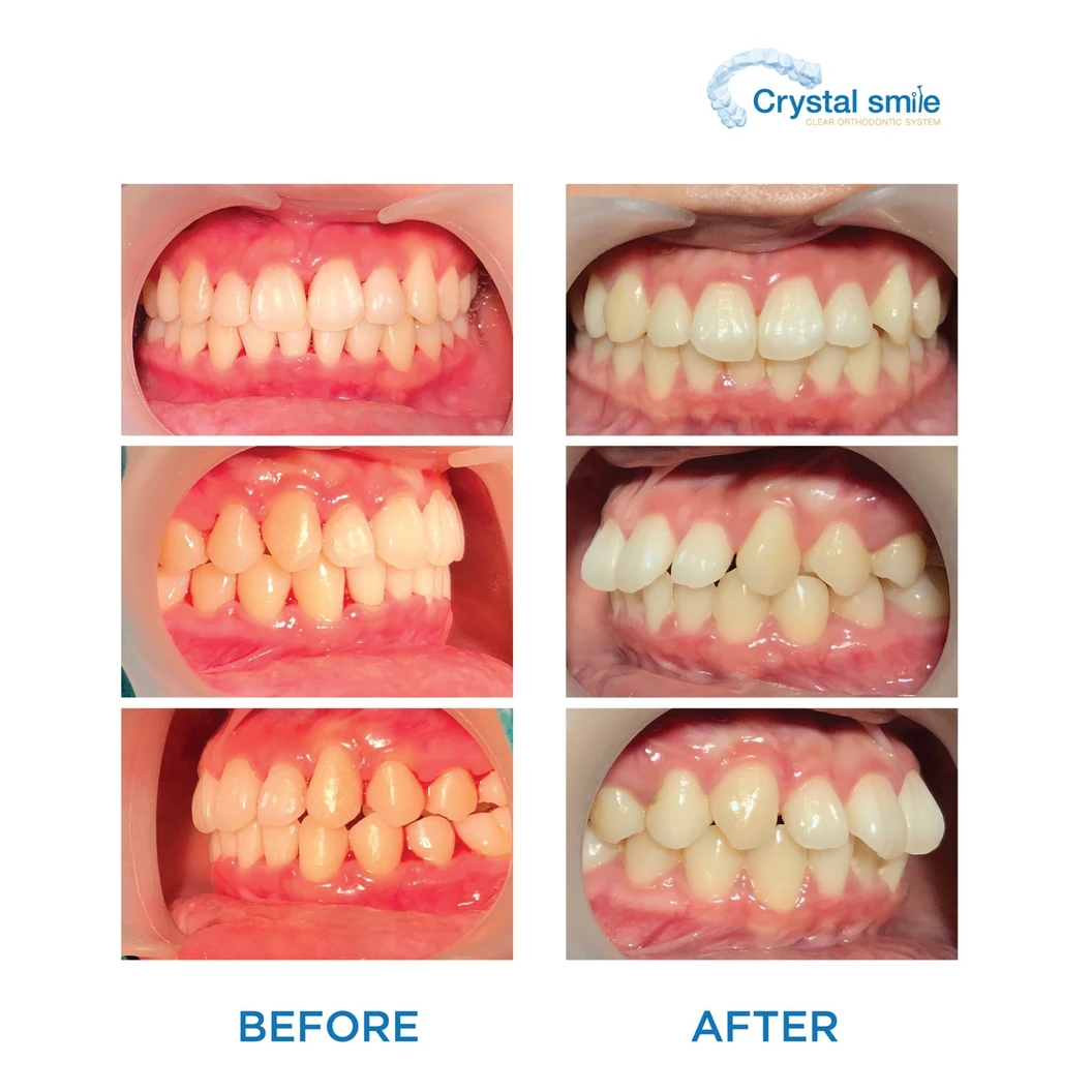 คอร์สจัดฟันแบบใส Crystal Smile Moderate ฟันบนและล่าง เครื่องมือไม่เกิน 20 ชิ้น