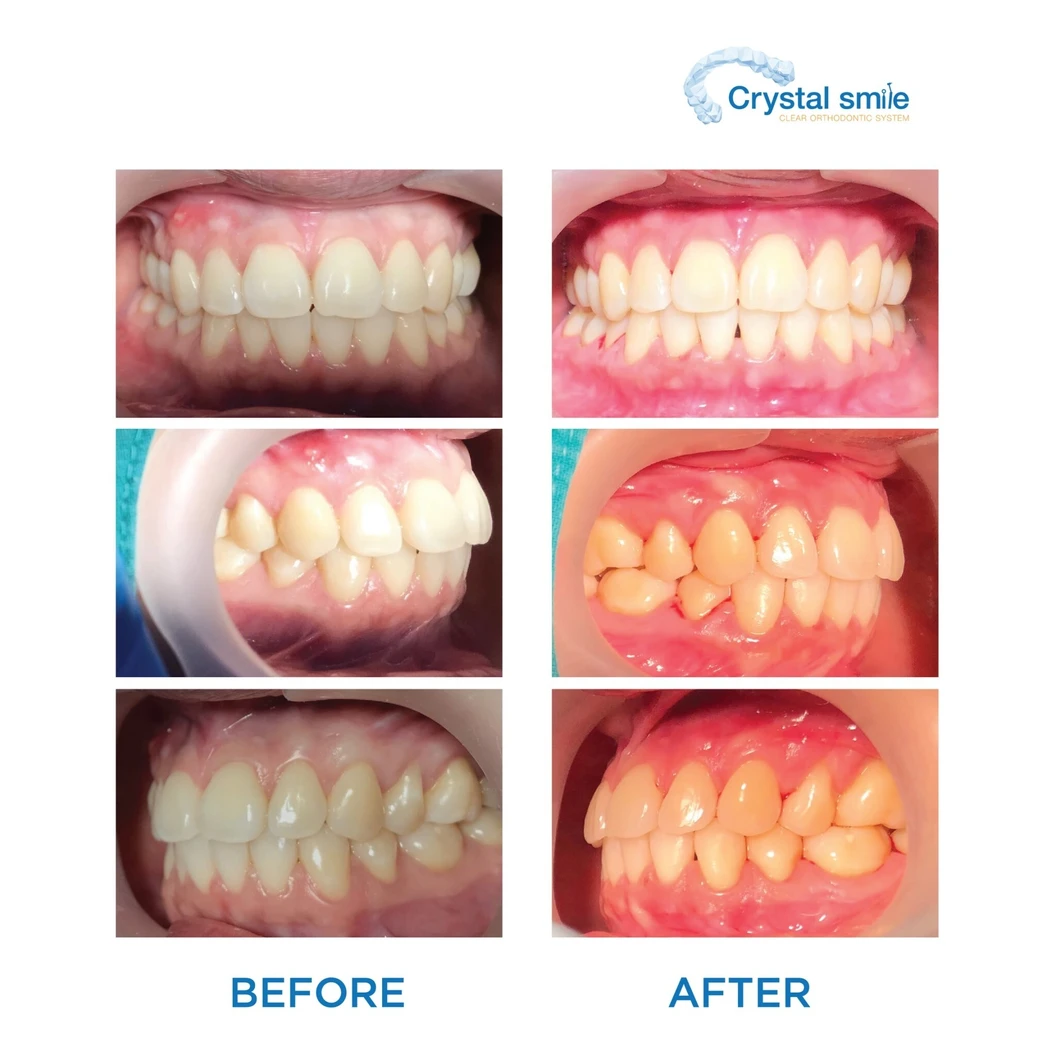 คอร์สจัดฟันแบบใส Crystal Smile Moderate ฟันบนและล่าง เครื่องมือไม่เกิน 20 ชิ้น