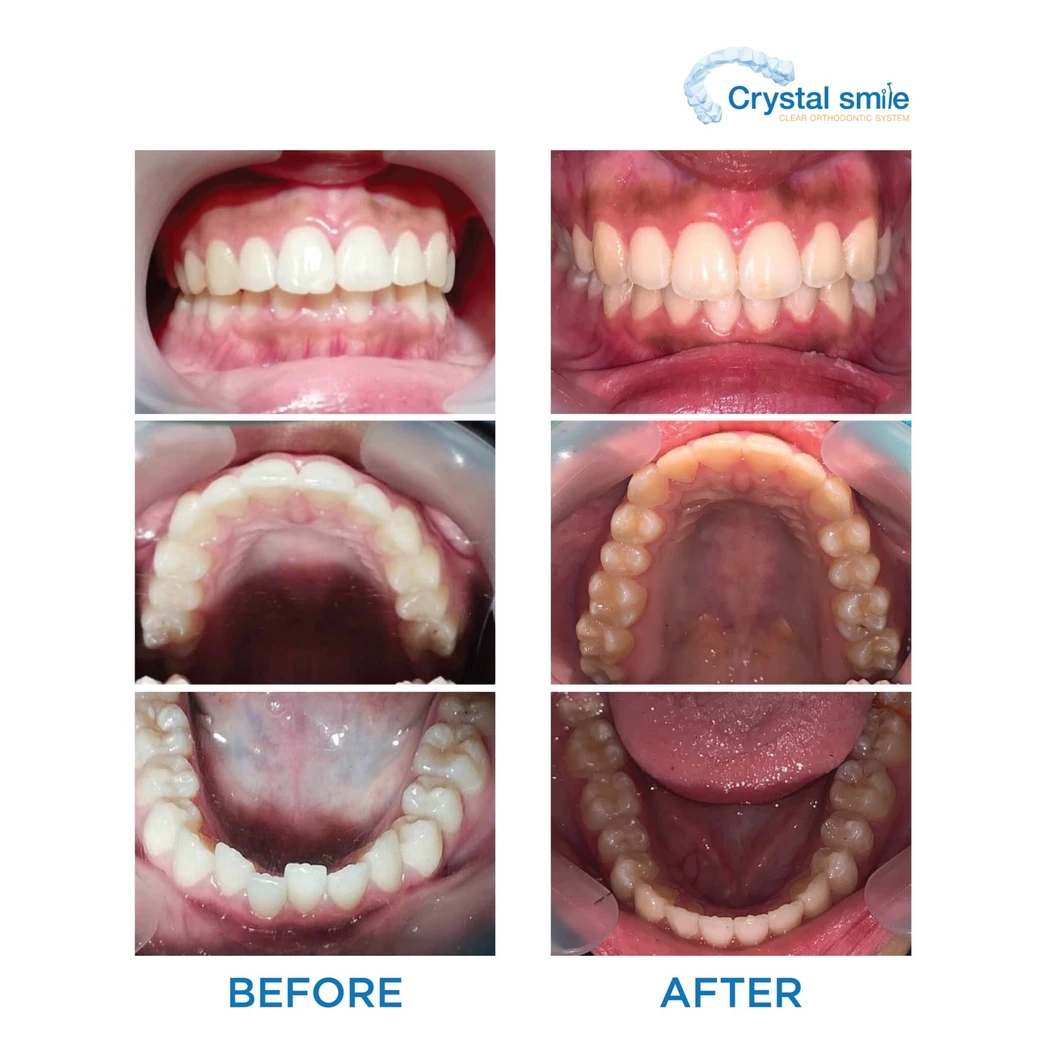 คอร์สจัดฟันแบบใส Crystal Smile Comprehensive ฟันบนและล่าง เครื่องมือ 20 ชิ้นขึ้นไป