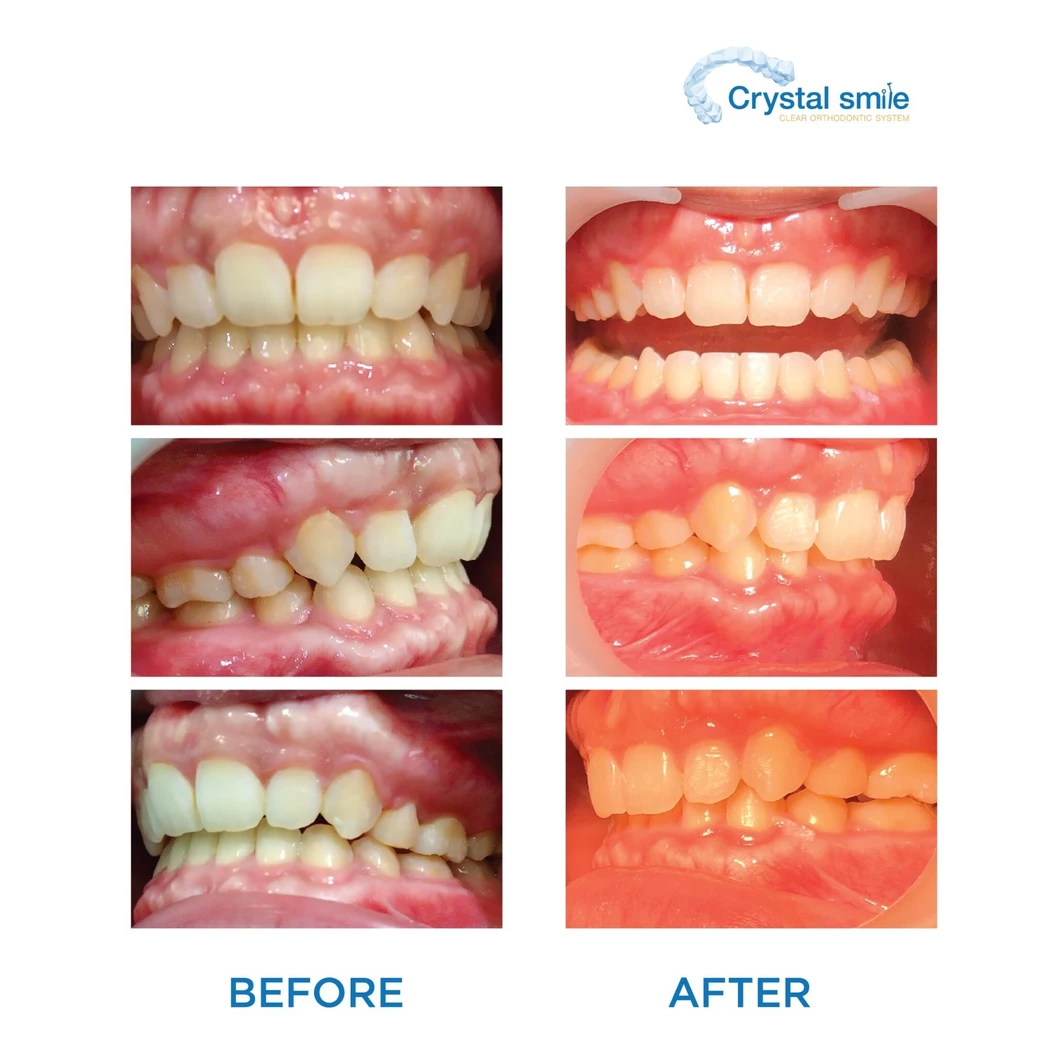 คอร์สจัดฟันแบบใส Crystal Smile Comprehensive ฟันบนและล่าง เครื่องมือ 20 ชิ้นขึ้นไป