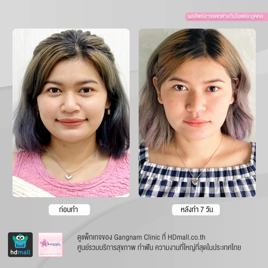 ทำ HIFU เครื่อง Ultra V HIFU Plus ไม่จำกัดช็อต บริเวณแก้มและร่องแก้ม 1 ครั้ง