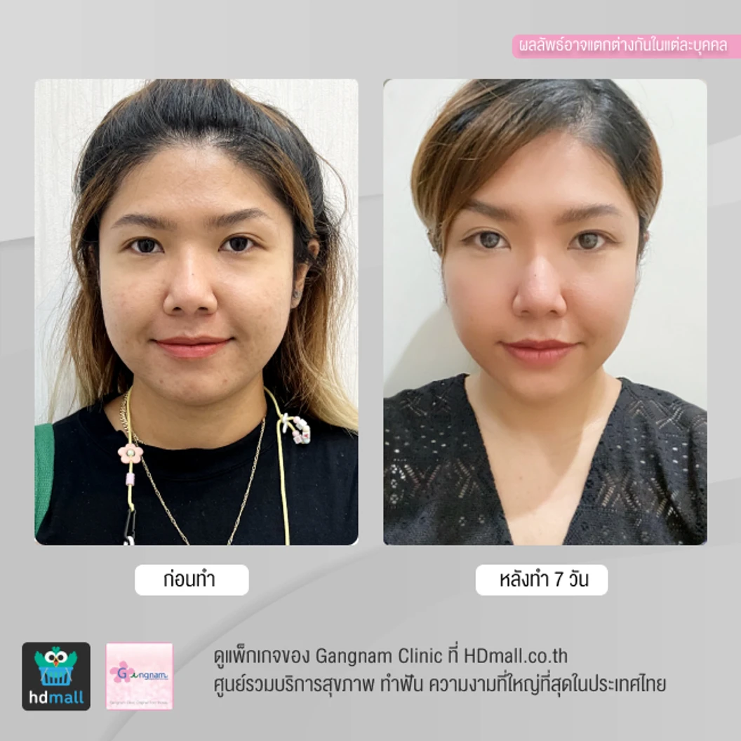 ทำ HIFU เครื่อง Ultra V HIFU Plus ไม่จำกัดช็อต บริเวณแก้มและร่องแก้ม 1 ครั้ง