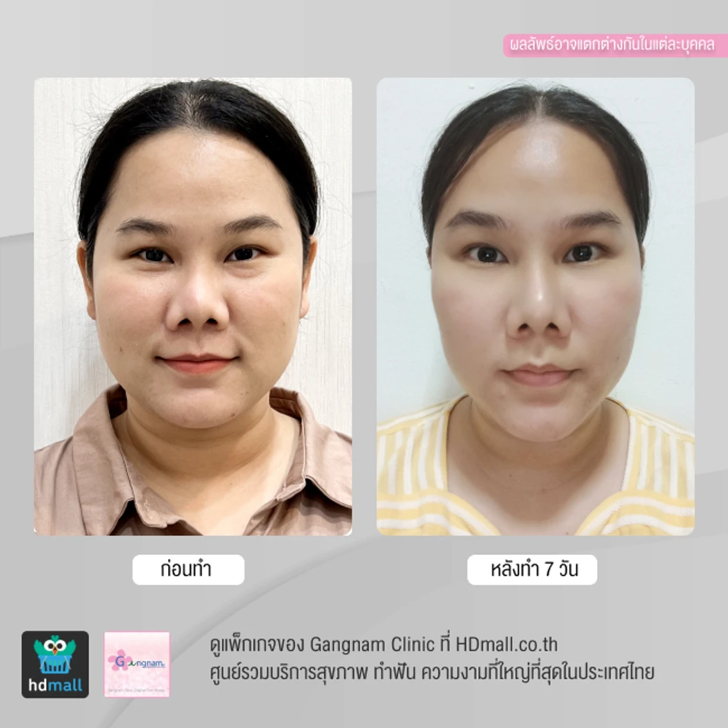 ทำ HIFU เครื่อง Ultra V HIFU Plus ไม่จำกัดช็อต บริเวณแก้มและร่องแก้ม 1 ครั้ง