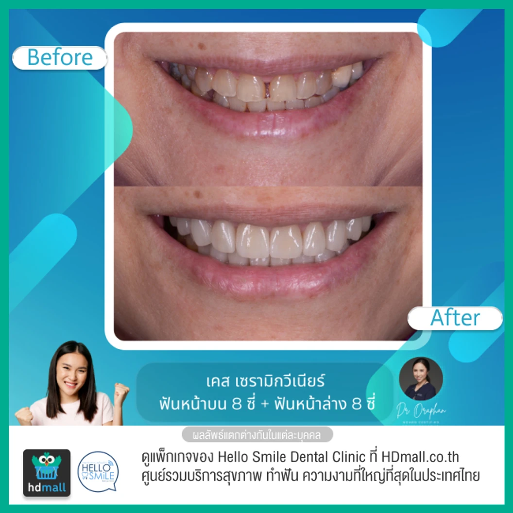 ทำวีเนียร์เซรามิกพอร์ซเลน สำหรับฟัน 16 ซี่