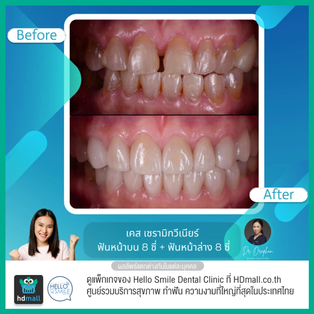 ทำวีเนียร์เซรามิกพอร์ซเลน สำหรับฟัน 16 ซี่